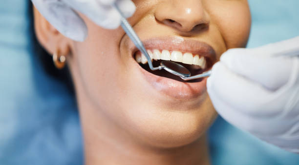 Best Chipped Tooth Repair Near Me  in Kiln, MS